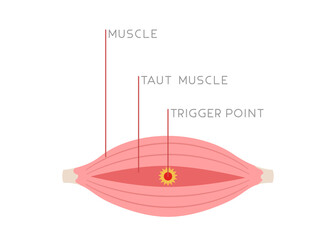 Illustration of tight muscle fibers with trigger point isolated on white background. Concept of injury, muscle pain, Myofascial pain, medical illustration. Flat vector.