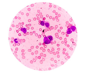 Canvas Print - Photomicrograph of Acute Myeloblastic Leukemia or AML, a cancer of white blood cell.