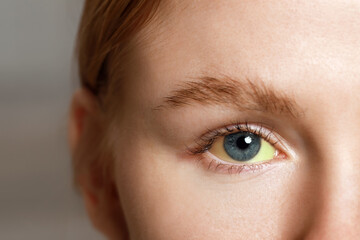 Poster - Woman with yellow eyes on blurred background, closeup. Symptom of hepatitis