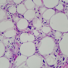 Sticker - Camera photo of lipoblast in liposarcoma, showing vacuolated cytoplasm and scalloping nuclei, magnification 400x, photograph through a microscope