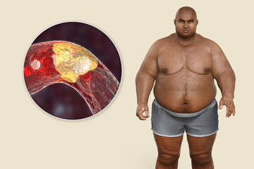 Poster - Obesity and atherosclerosis, conceptual 3D illustration. Atheromatous plaque inside artery leading to narrowing of blood vessel in an obese person