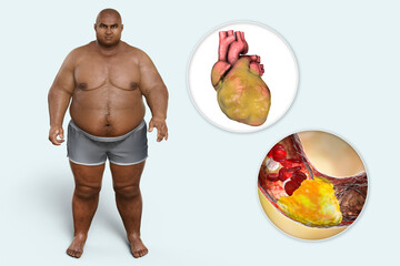 Poster - Obesity and atherosclerosis, 3D illustration. Atheromatous plaque inside artery of obese heart leading to narrowing of blood vessel in an obese person