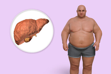 Wall Mural - Fibrotic liver in obese man, 3D illustration. Concept of obesity and inner organs diseases