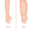 Edema arm. Swollen hand, fingers, wrist, forearm