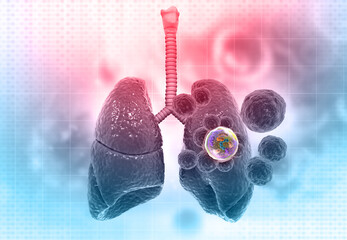 Wall Mural - Human lung cancer concept. 3d illustration.