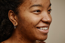 Close Up Ethnic Young Woman With Acne Scars On Face Smiling