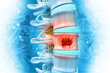 Spine cancer or spinal tumor disease. 3d illustration