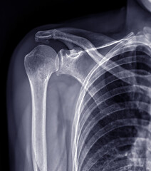 Poster - X-ray Shoulder joint shoulder front view for diagnosis fracture of shoulder joint.