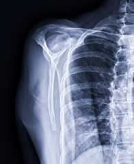 Poster - X-ray Shoulder joint shoulder front view for diagnosis fracture of shoulder joint.