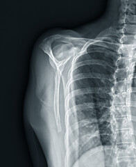 Poster - X-ray Shoulder joint shoulder front view for diagnosis fracture of shoulder joint.