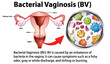 © blueringmedia - Bacterial Vaginosis (BV) infographic with explanation