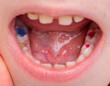 Child's mouth with multi-colored red and blue dental fillings after dental treatment in pediatric dentistry. Modern technology for children.