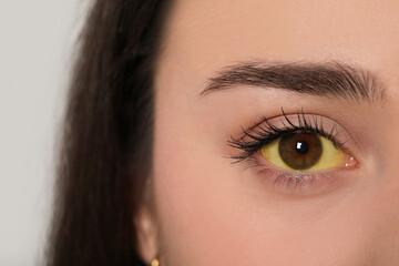 Poster - Woman with yellow eyes on light background, closeup. Symptom of hepatitis