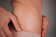 © epovdima - Young woman touching stretch marks on her body