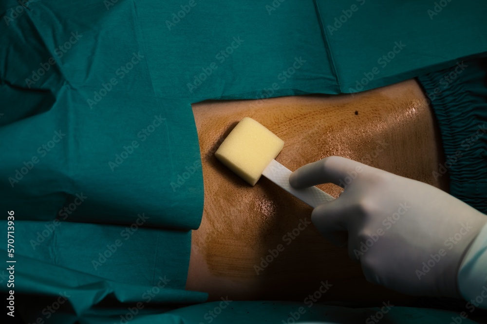 Doctor or surgeon apply betadine to the patient for anesthesia ...