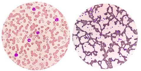 Canvas Print - Blood Film or Peripheral blood smear: Microcytic hypochromic anemia with Thrombocytosis.