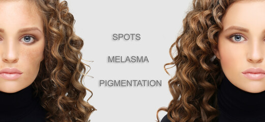 Dark spots, freckles,hyperpigmentation(melasma or chloasma),concept - skin lightening, skin whitening, fruit acids,AHA, Skin Brightening