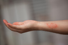 Spots, Sores On Human Skin. Infection Rash, Psoriasis, Eczema, Lichen. Allergies And Dermatitis. Work Injury. Scorch
