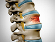 Traumatic Spine Fracture and vertebral injury medical concept as a human anatomy spinal column with a broken burst vertebra due to compression or other osteoporosis back disease