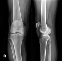 Poster - film x-ray both knee joint ap view for diagnosis knee pain from osteoarthritis knee and fracture .