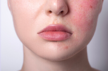 rosacea couperose redness skin, red spots on cheeks, young woman with sensitive skin, patient face before after result close-up 