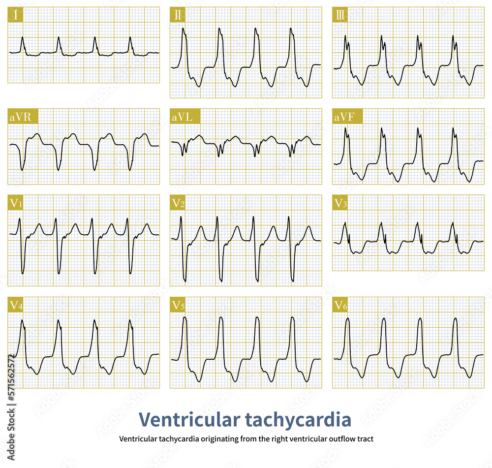 Ventricular tachycardia originating from the right ventricular outflow ...