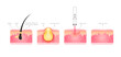 © Adisak - Acne scar vascular laser treatment. Inflammation associated with pimples. The structure of the skin acne scar. Medical beauty skin care concept. File PNG 3D.