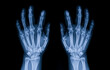 Blue tone radiograph on dark background in hospital.Doctor used xray for diagnosis of the illness of patient.Normal x-ray of both hands. Osteoarthritis of hand and joint. X-ray both hands in hospital.