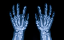 Blue Tone Radiograph On Dark Background In Hospital.Doctor Used Xray For Diagnosis Of The Illness Of Patient.Normal X-ray Of Both Hands. Osteoarthritis Of Hand And Joint. X-ray Both Hands In Hospital.
