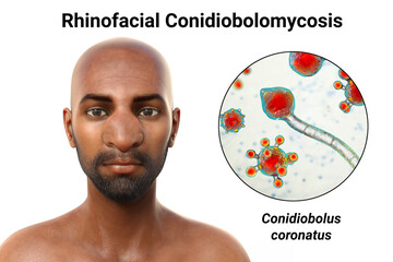 Wall Mural - Rhinofacial conidiobolomycosis in a man and Conidiobolus coronatus fungi, 3D illustration