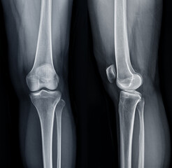 Poster - film x-ray of left knee joint ap and lateral view for diagnosis knee pain from osteoarthritis knee a