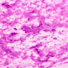 Sticker - Scalp swelling cytology: Epidermal inclusion cyst. commonly called 