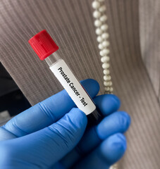 Canvas Print - Blood sample tube for Prostate cancer test. Cancer screening tests. PSA test.