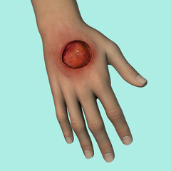 Wall Mural - Buruli ulcer on an arm, 3D illustration. The disease caused by Mycobacterium ulcerans bacteria