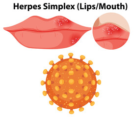 Canvas Print - Herpes simplex virus (Lips/Mouth)