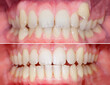 © Ivan - Complete smile makeover from crooked teeth to well aligned smile. Before/after after using aligners invisalign or brackets