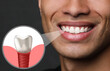 © New Africa - Happy African American man with perfect teeth smiling on black background, closeup. Illustration of dental implant