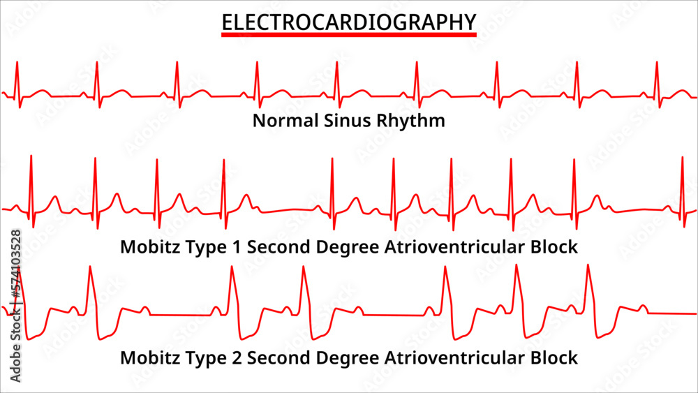 Set of ecg common abnormalities normal sinus rhythm mobitz type 1