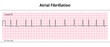 ECG Atrial Fibrillation - 8 Second ECG Paper - Electrocardiography Vector Medical Illustration