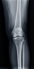 Poster - film x-ray of left knee joint ap view for diagnosis knee pain from osteoarthritis knee and fracture 