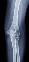 Poster - x-ray of elbow join showing normal elbow joint.
