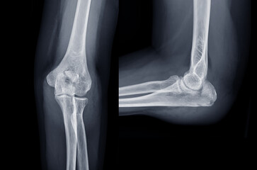 Poster - x-ray of elbow join showing fracture of ulna bone.