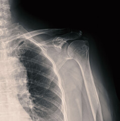 Poster - X-ray Shoulder joint shoulder front view for diagnosis fracture of shoulder joint.