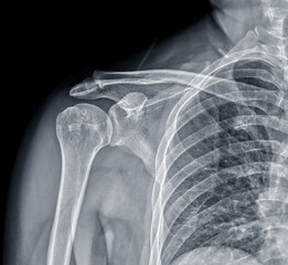 Poster - X-ray Shoulder joint shoulder front view for diagnosis fracture of shoulder joint.