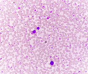 Canvas Print - Chronic myeloid leukemia (CML) in accelerated phase with thrombocytosis. Chronic myelogenous leukemia.