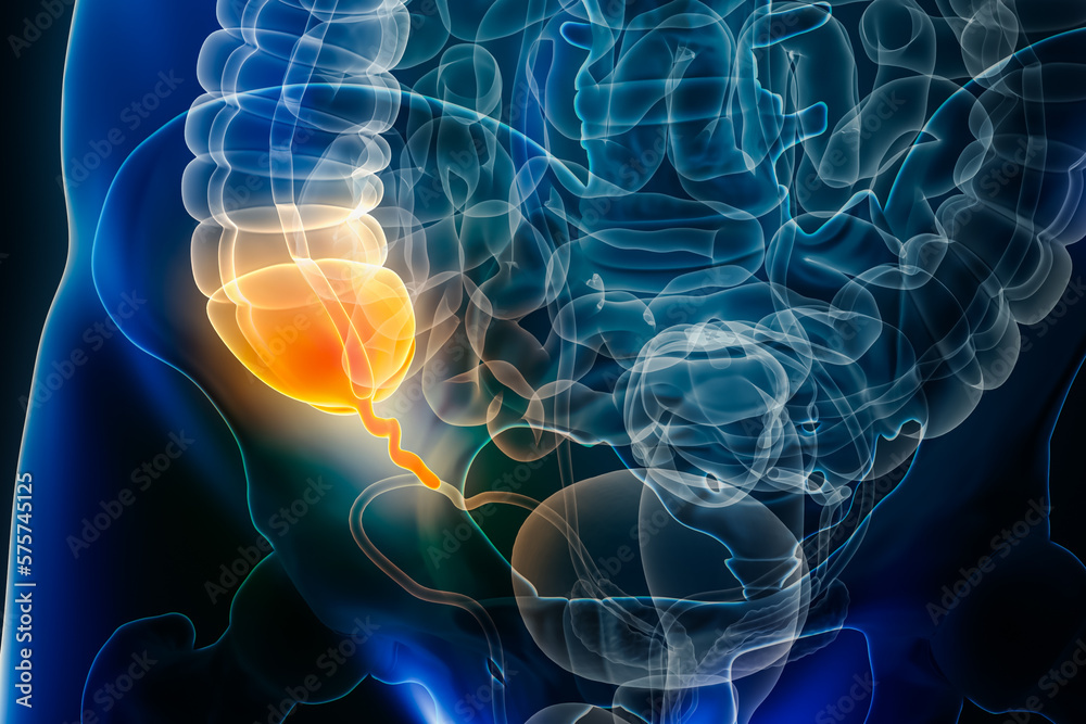 Appendicitis disease or vermiform appendix inflammation 3D rendering ...