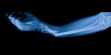 Blue Tone Radiograph On Dark Background In Hospital.Doctor Used Xray For Diagnosis.Forearm Fracture In Accident Patient.X-ray Of Child Or Children In Orthopedic Surgery Unit.