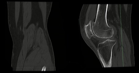 Poster - ct scan of knee joint.