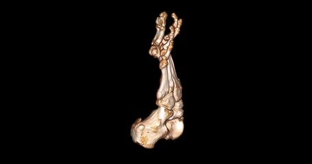 Poster -  CT Scan of foot  3D rendering for diagnosis bone fracture.