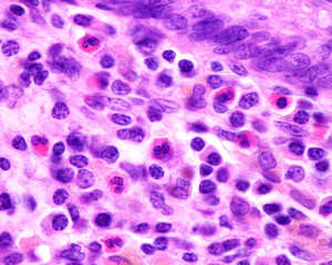 Poster - Human appendix. Eosinophils